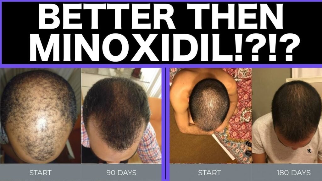 Minoxidil alternatives: Minoxidil vs nanoxidil