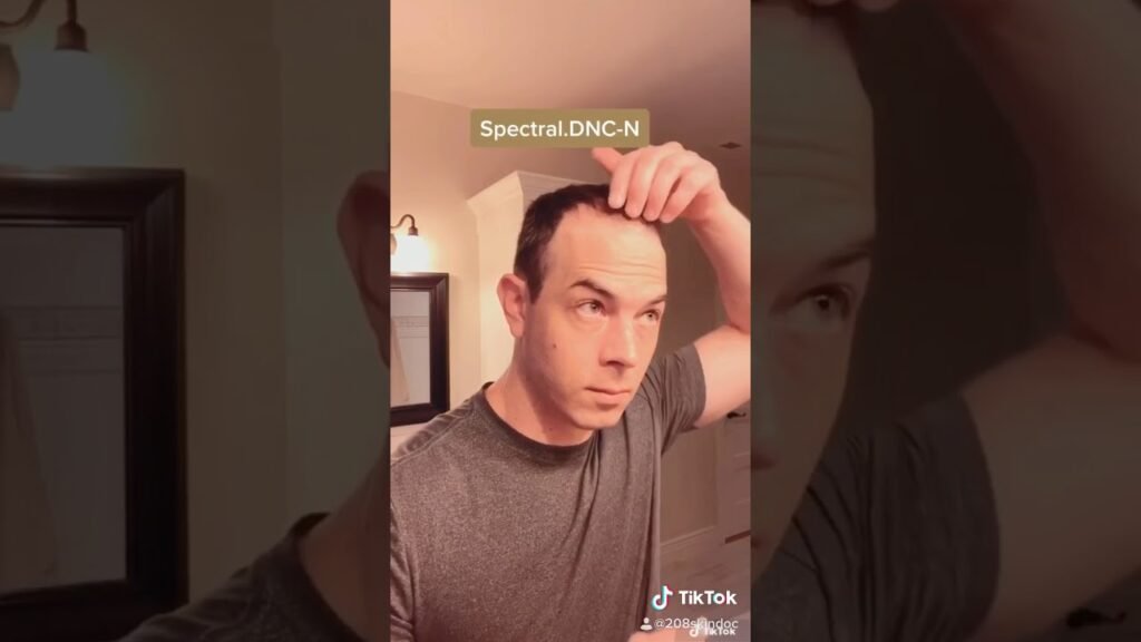 Side-by-side review of Minoxidil vs nanoxidil