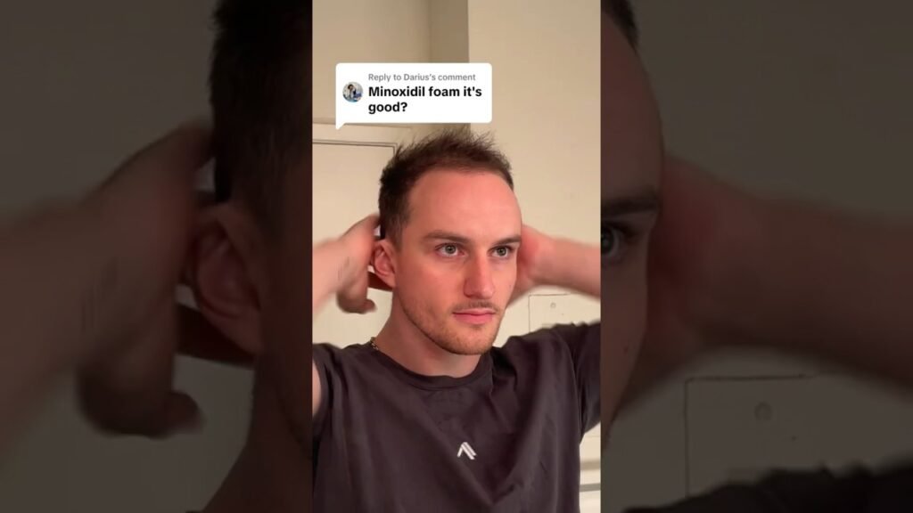 Comparing results from Foam vs liquid minoxidil
