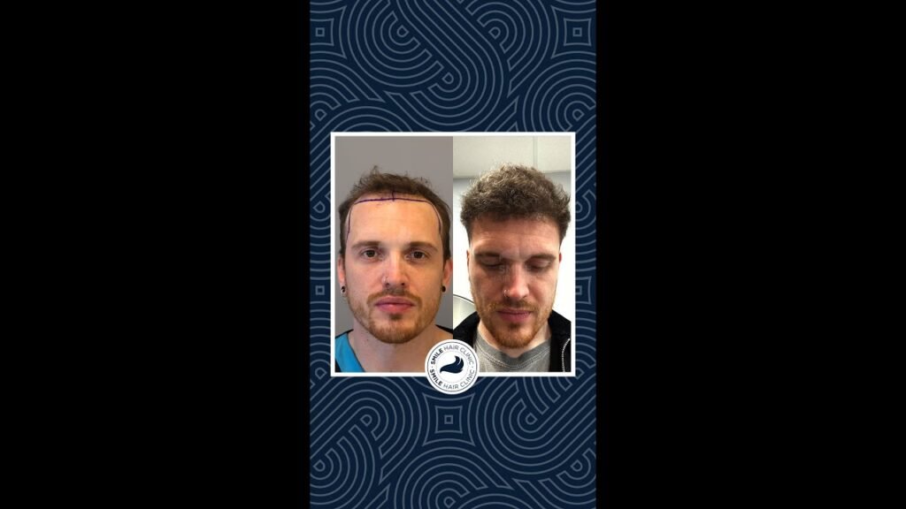 Complete comparison of Minoxidil vs hair transplant