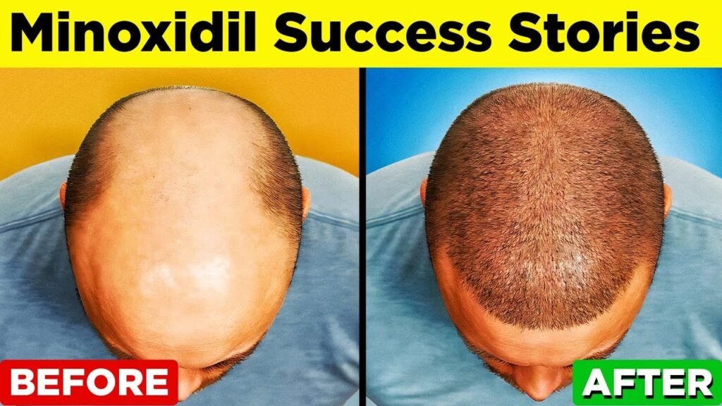 How to use Minoxidil effectiveness