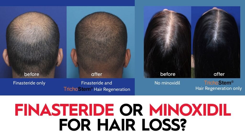 Which is better: Minoxidil vs finasteride