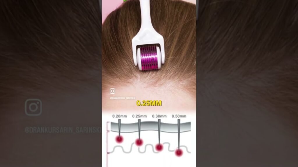 Why choose Minoxidil vs derma roller