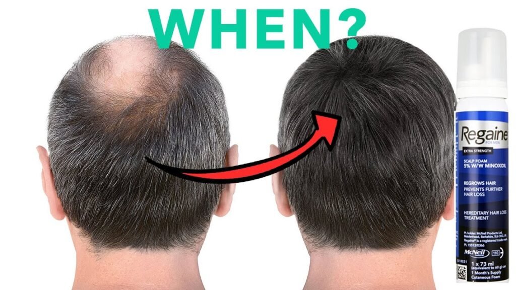 Why does How long does minoxidil last?