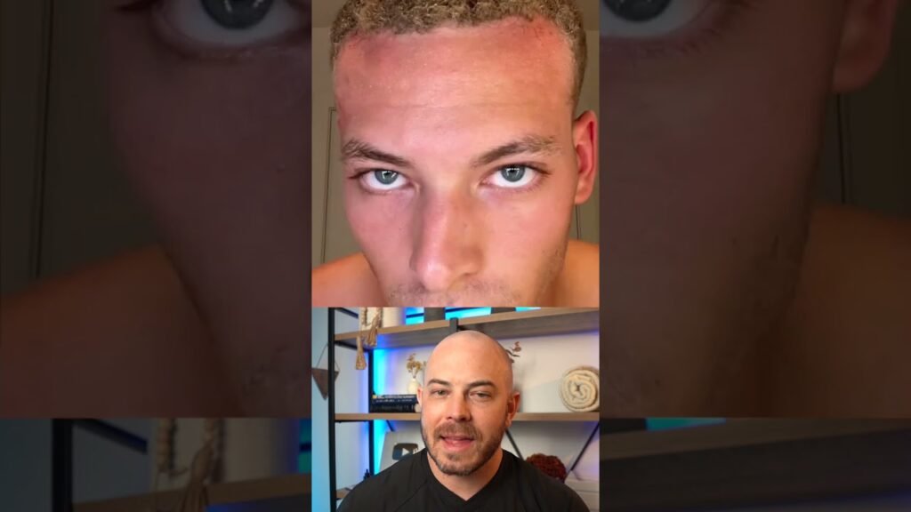 What to expect from Minoxidil vs derma roller