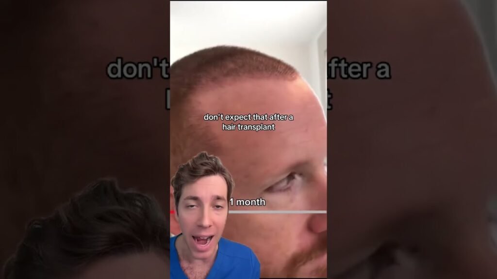 What to expect from Minoxidil vs hair transplant