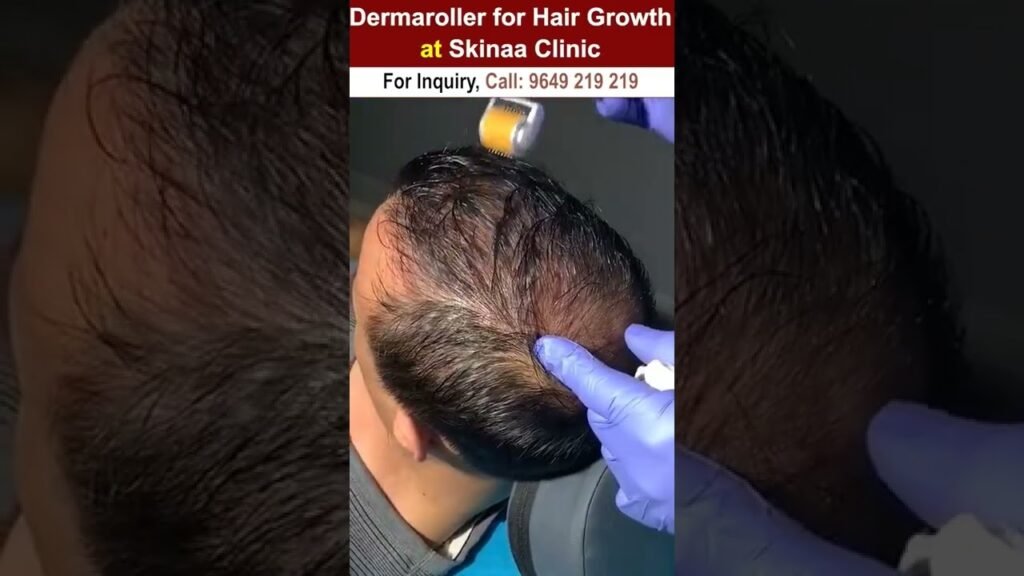 What works best: Minoxidil vs derma roller