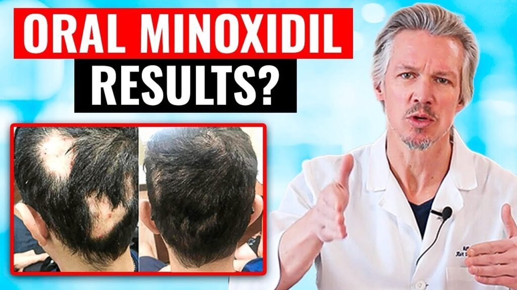 What happens if Minoxidil female dosage
