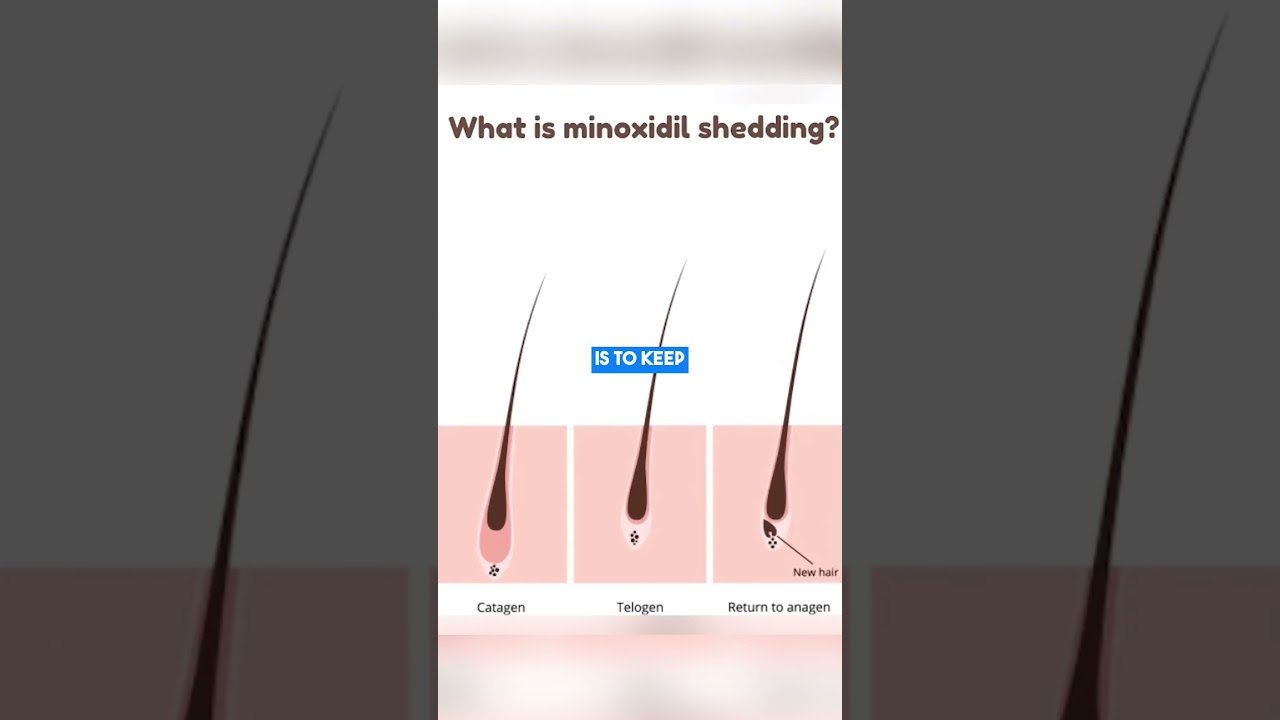 Can Minoxidil results